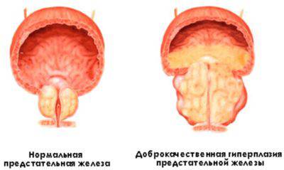Доброкачественная гиперплазия простаты