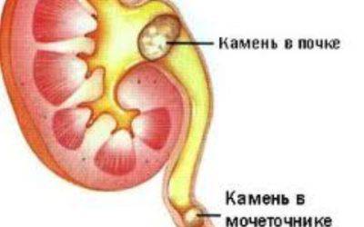 Выведение камня с мочой